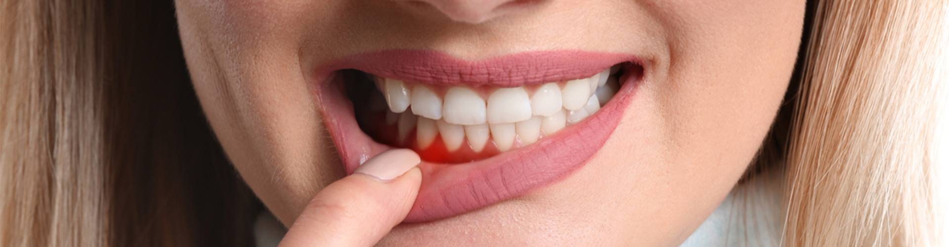 woman revealing red gums