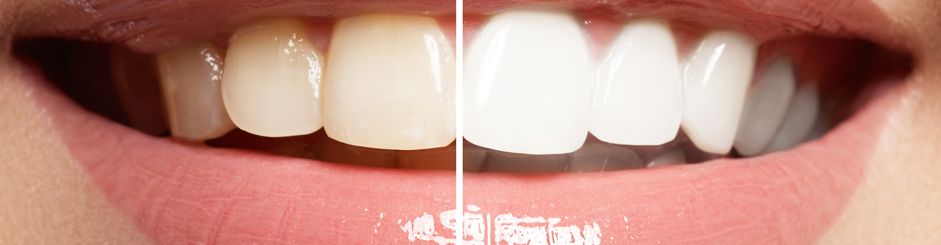 split image of a woman's smile before and after teeth whitening
