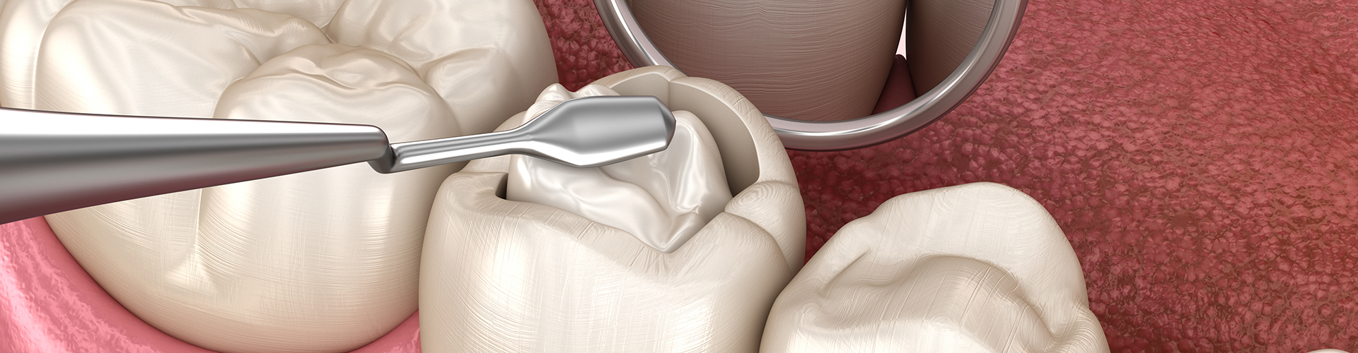 rendering of a cavity being filled