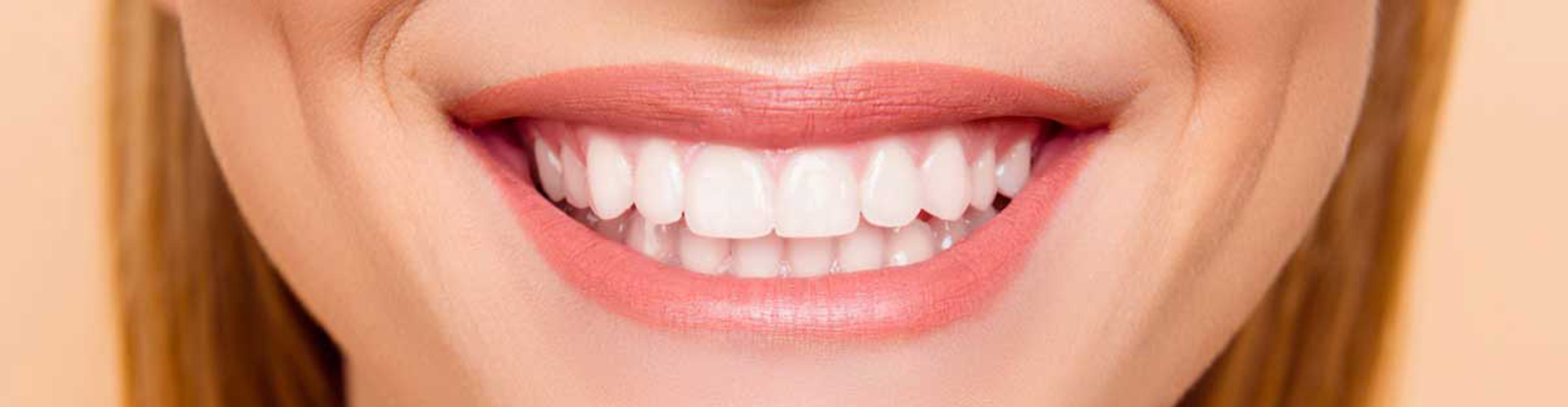 woman smiling with veneers