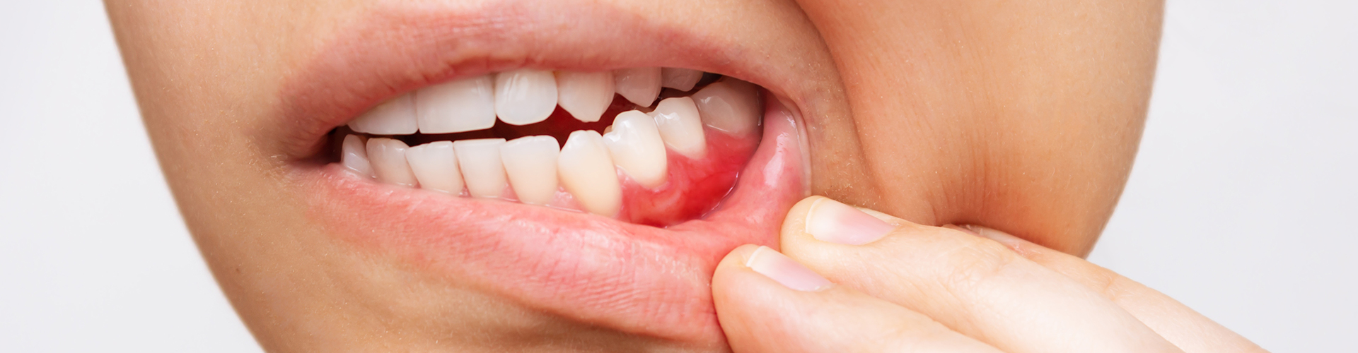 woman pulling down lip to reveal inflamed gum