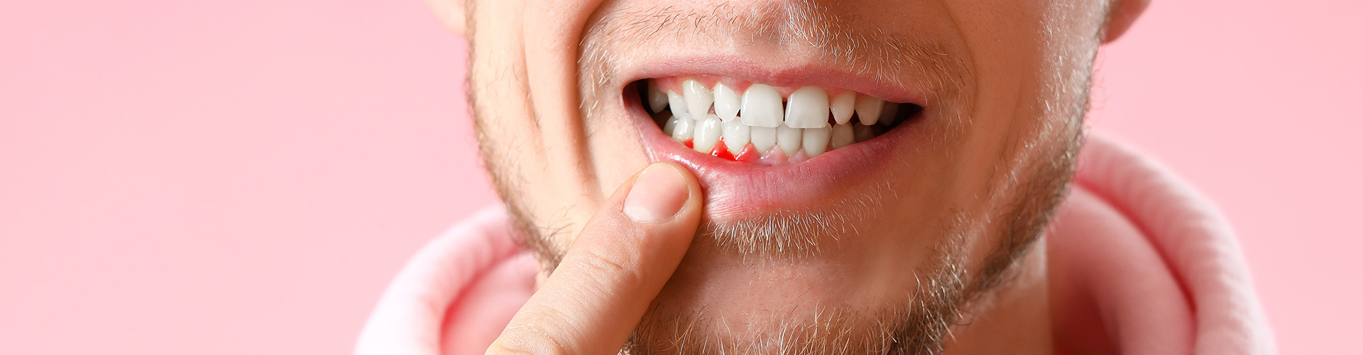 man pulling down lip to reveal inflamed gum