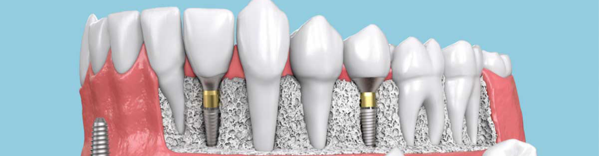 illustration of mouth with implants 