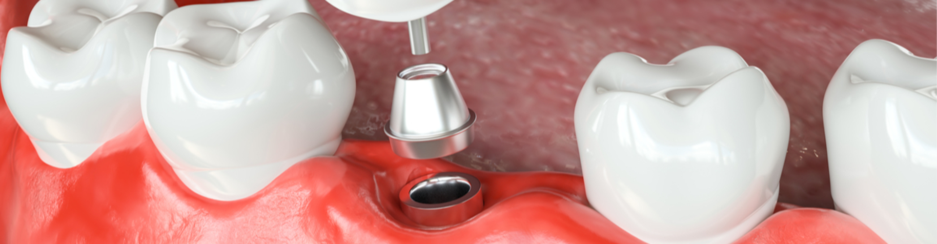 tooth with drill illustration