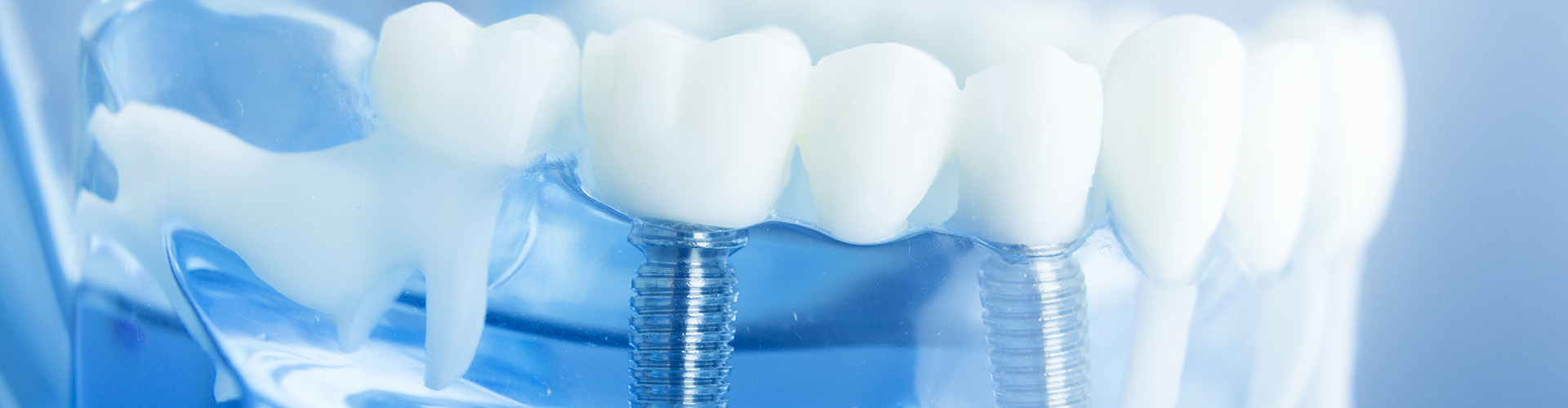 model of a dental bridge supported by two dental implants