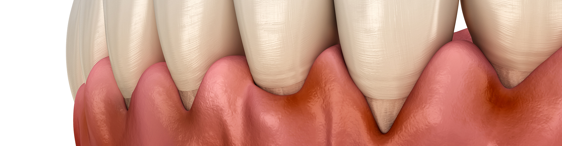 rendering of teeth with receeding gums