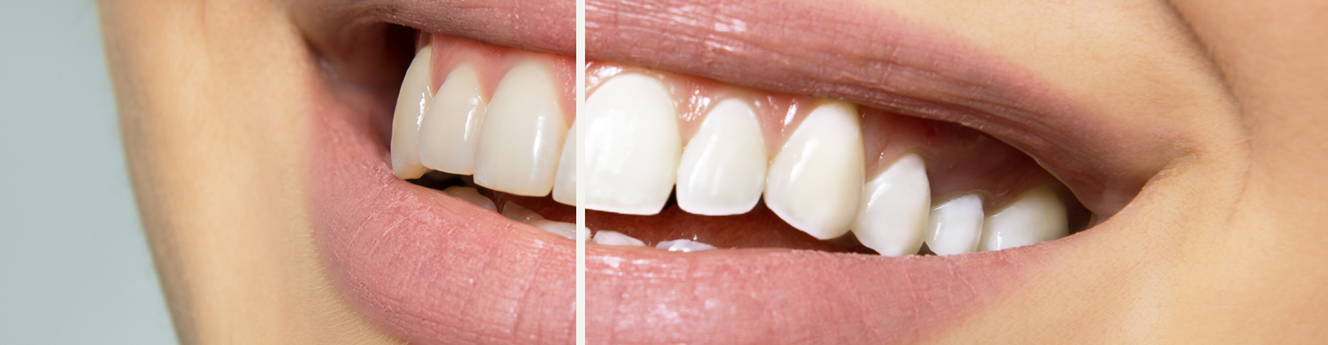 image of a woman's smile split into the before and after of teeth whitening