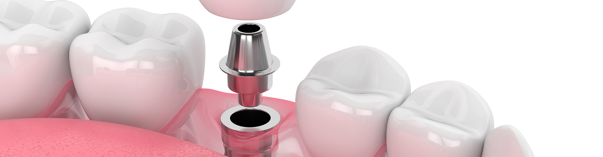 rendering of a crown being placed on an implant in a lower jaw