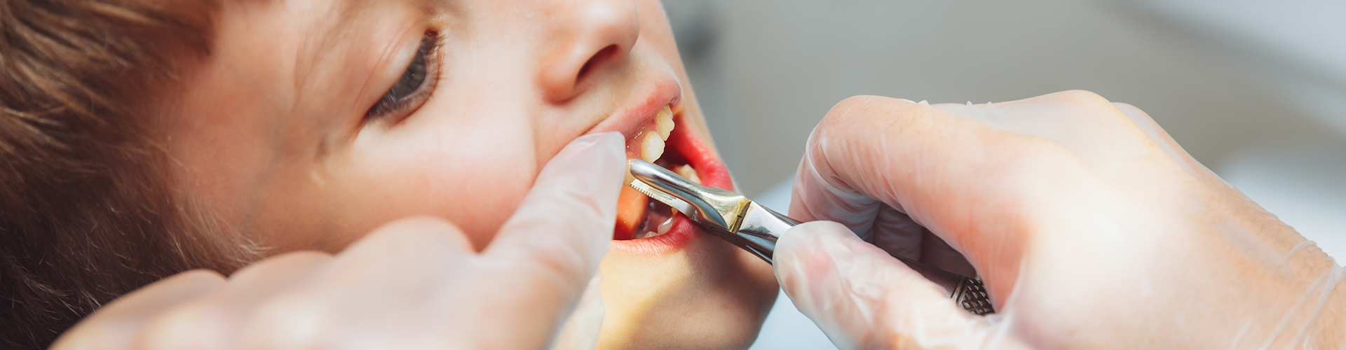 dentist extracting a child's tooth