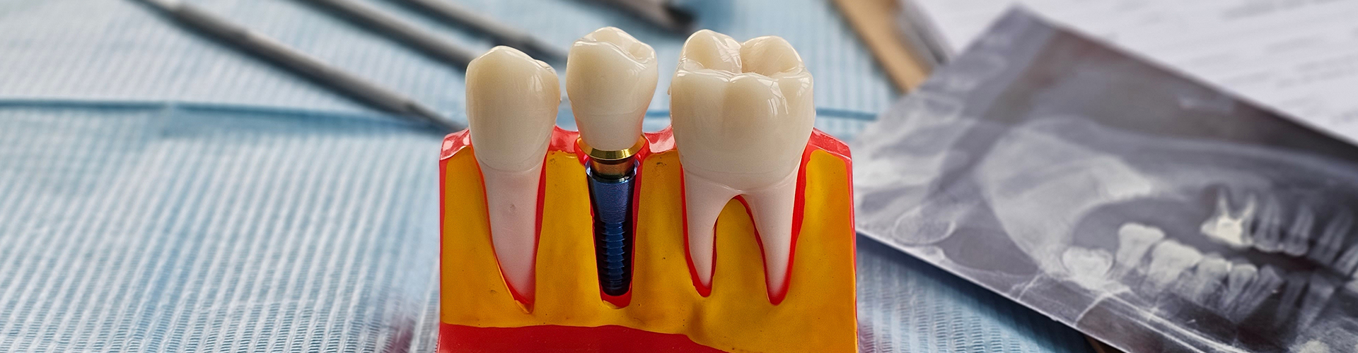 model of a tooth implant