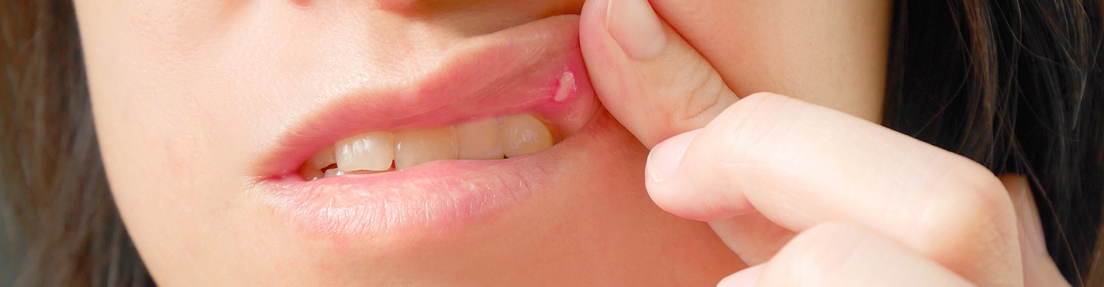 woman lifting upper lip to show canker sore