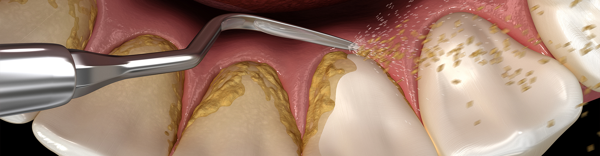 rendering of plaque removal from teeth