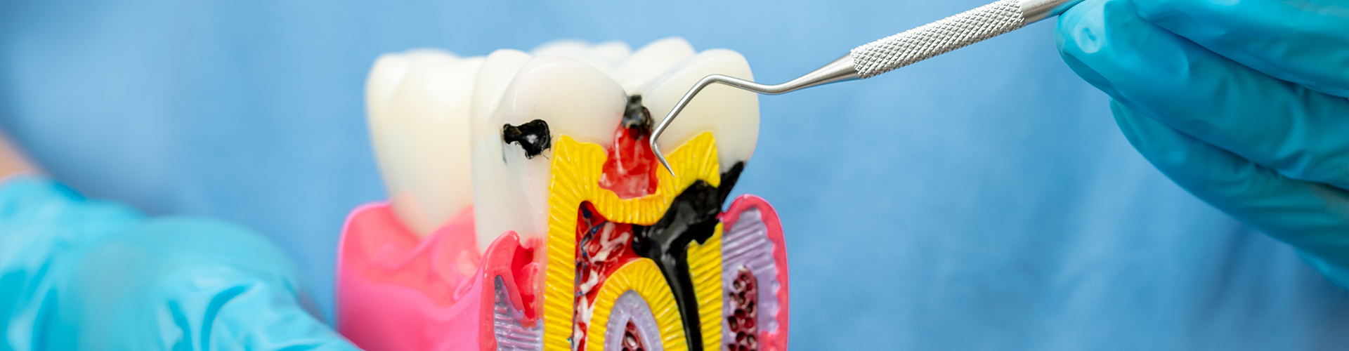 gloved hand holding a tooth model with a cavity showing root canals