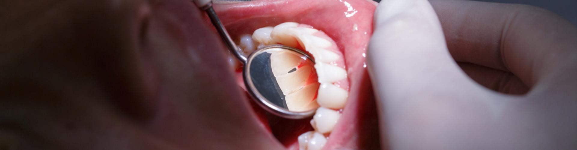 opened mouth with mirror inside of it
