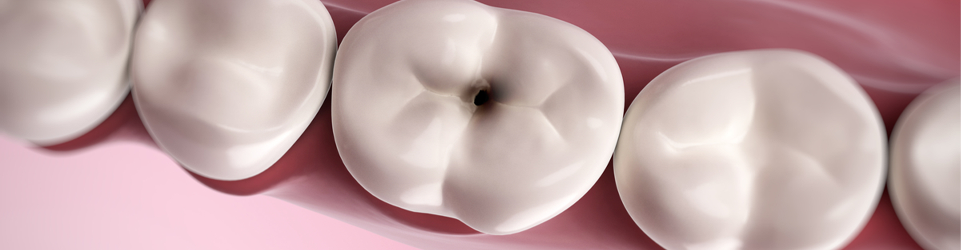 illustration of a tooth with a black hole in it