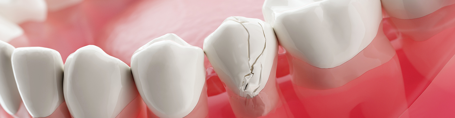 rendering of a cracked tooth