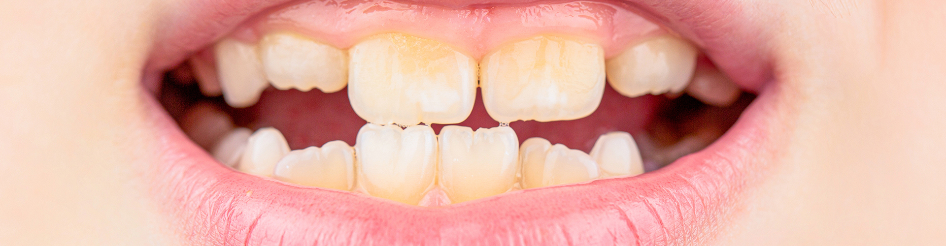 kids smile with plaque buildup on teeth