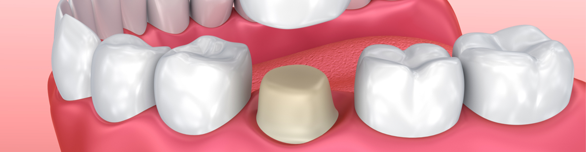 illustration of mouth with crown