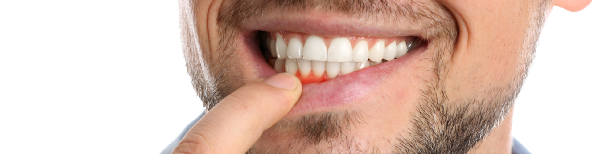 man pointing to his pink gums