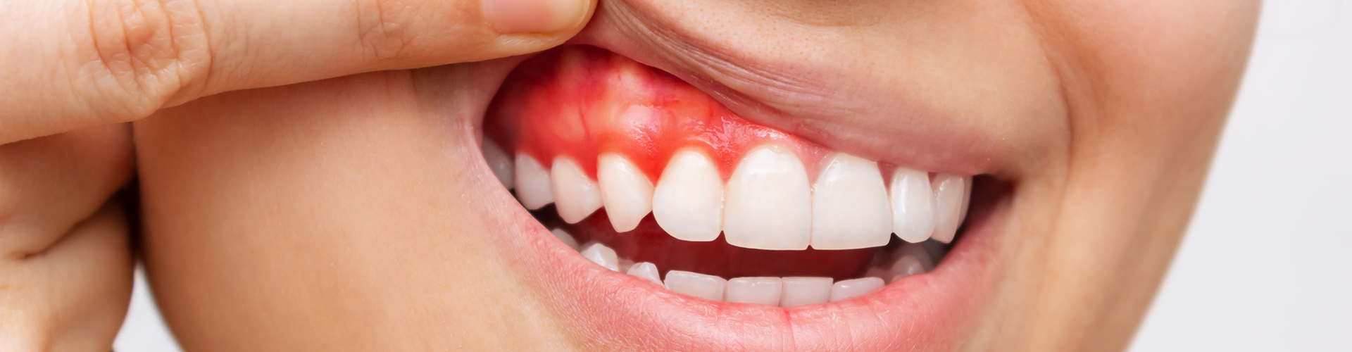 woman lifting lip to show inflamed gum
