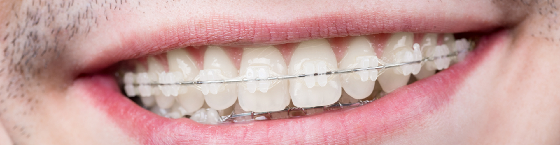 smile with ceramic braces on it