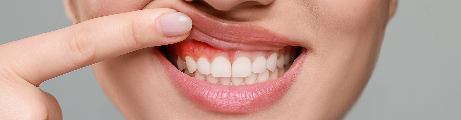 woman lifting top lip to show inflamed gums