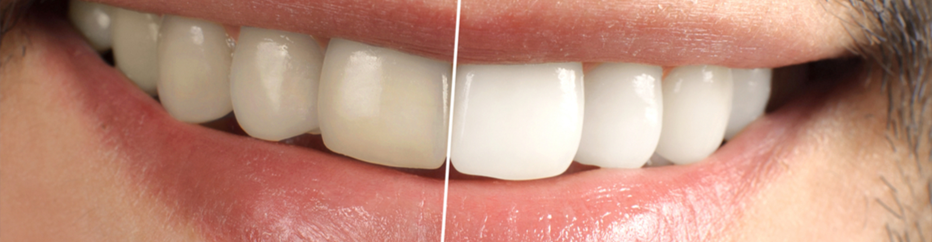smile with a line down the center half white and half yellower