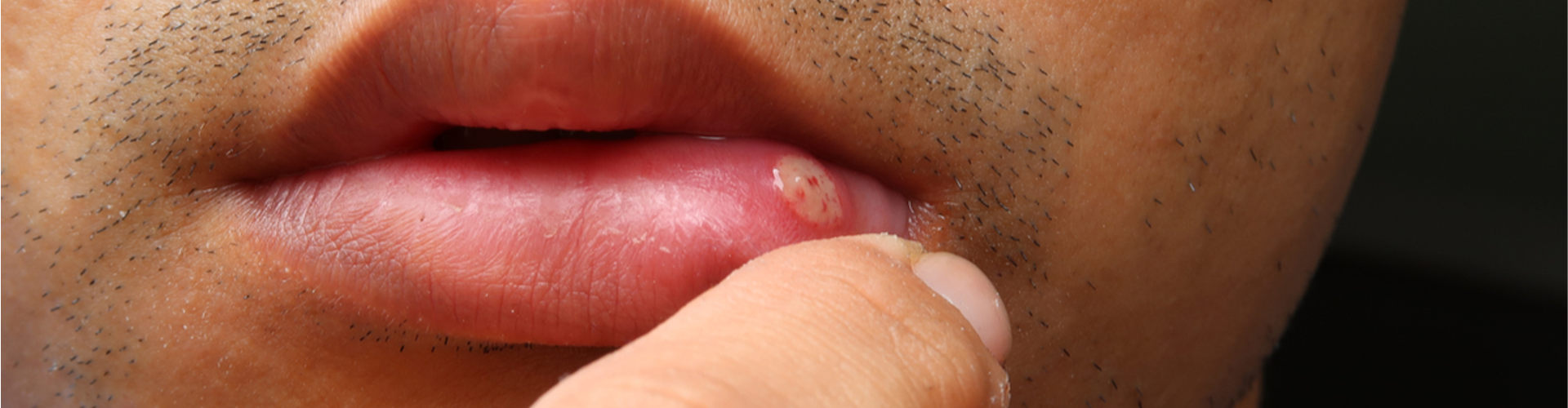 man holding his lip with a canker sore