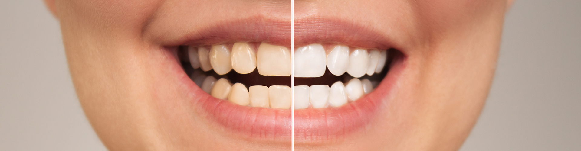 side-by-side of a woman's smile before and after whitening
