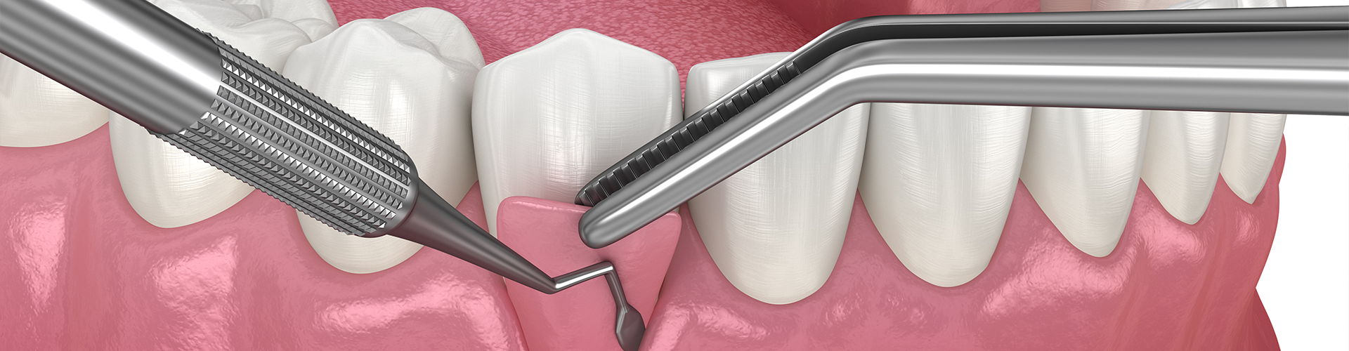 rendering of a gum graft being placed