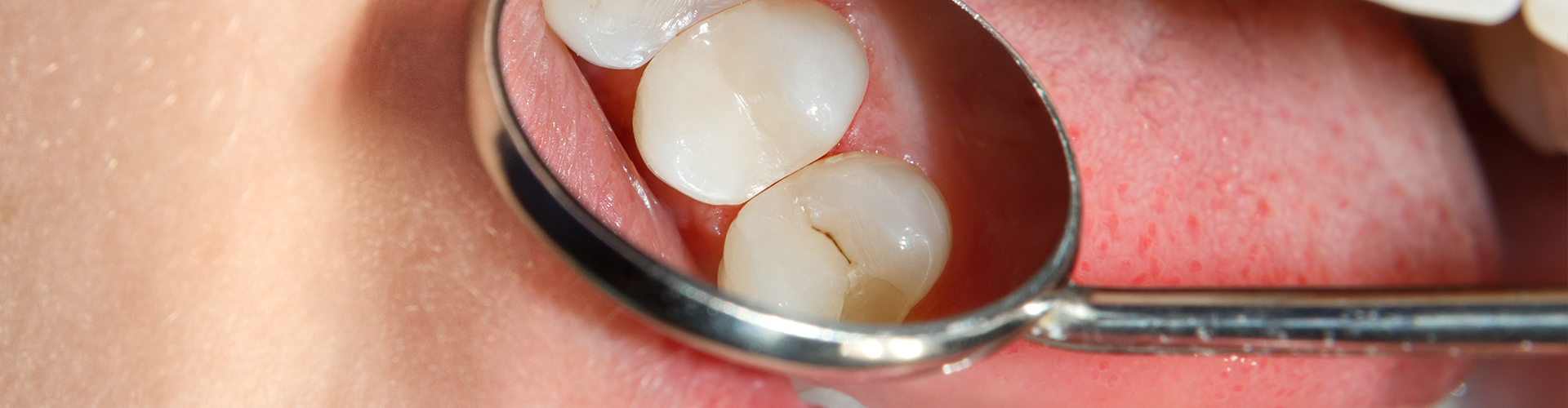 biting surface of upper teeth reflected in dental mirror