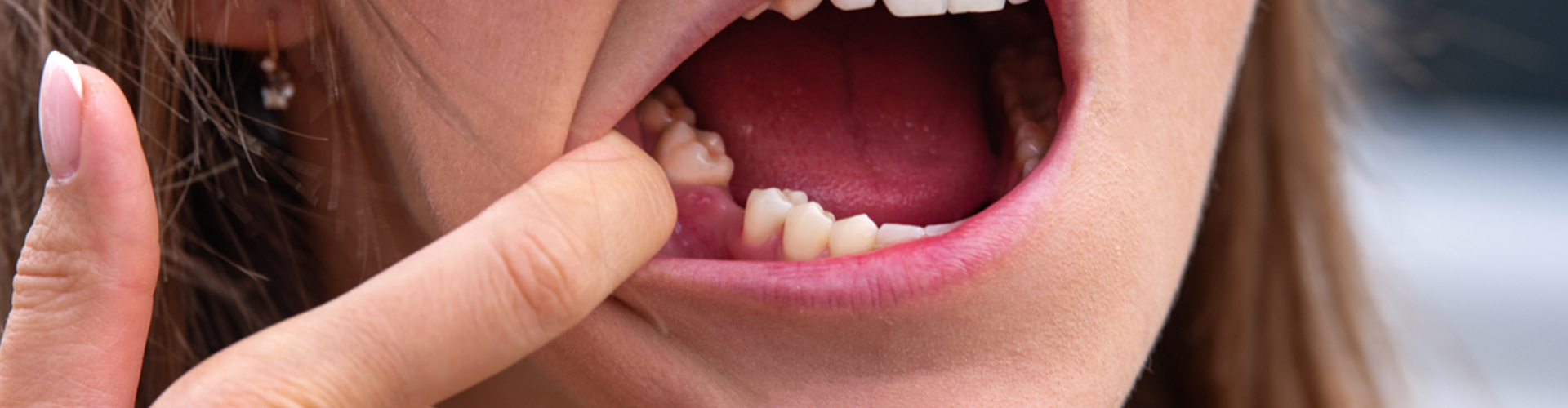 woman showing gap in teeth from missing tooth
