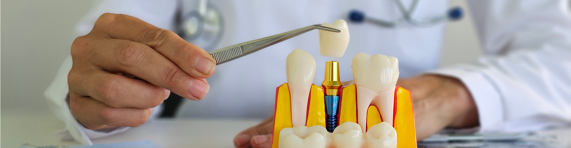 hands placing crown on dental implant model with tweezers