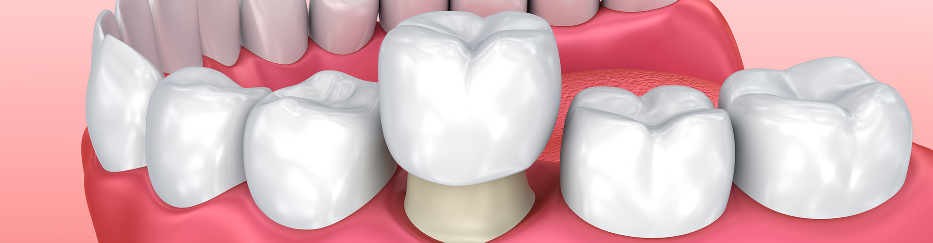 rendering of a dental crown being placed over a tooth