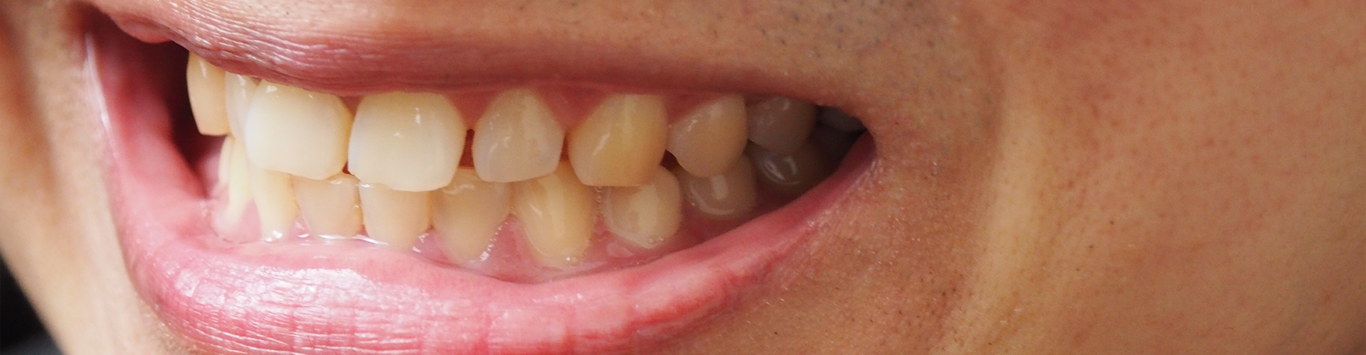 man smiling with yellowed teeth